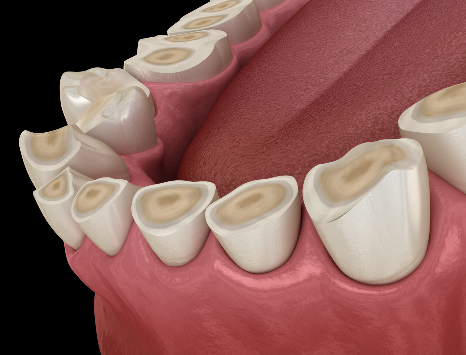 Treating Bruxism With Oral Appliances Lake Orion, MI