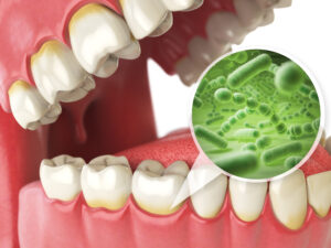 Lake orion gum disease