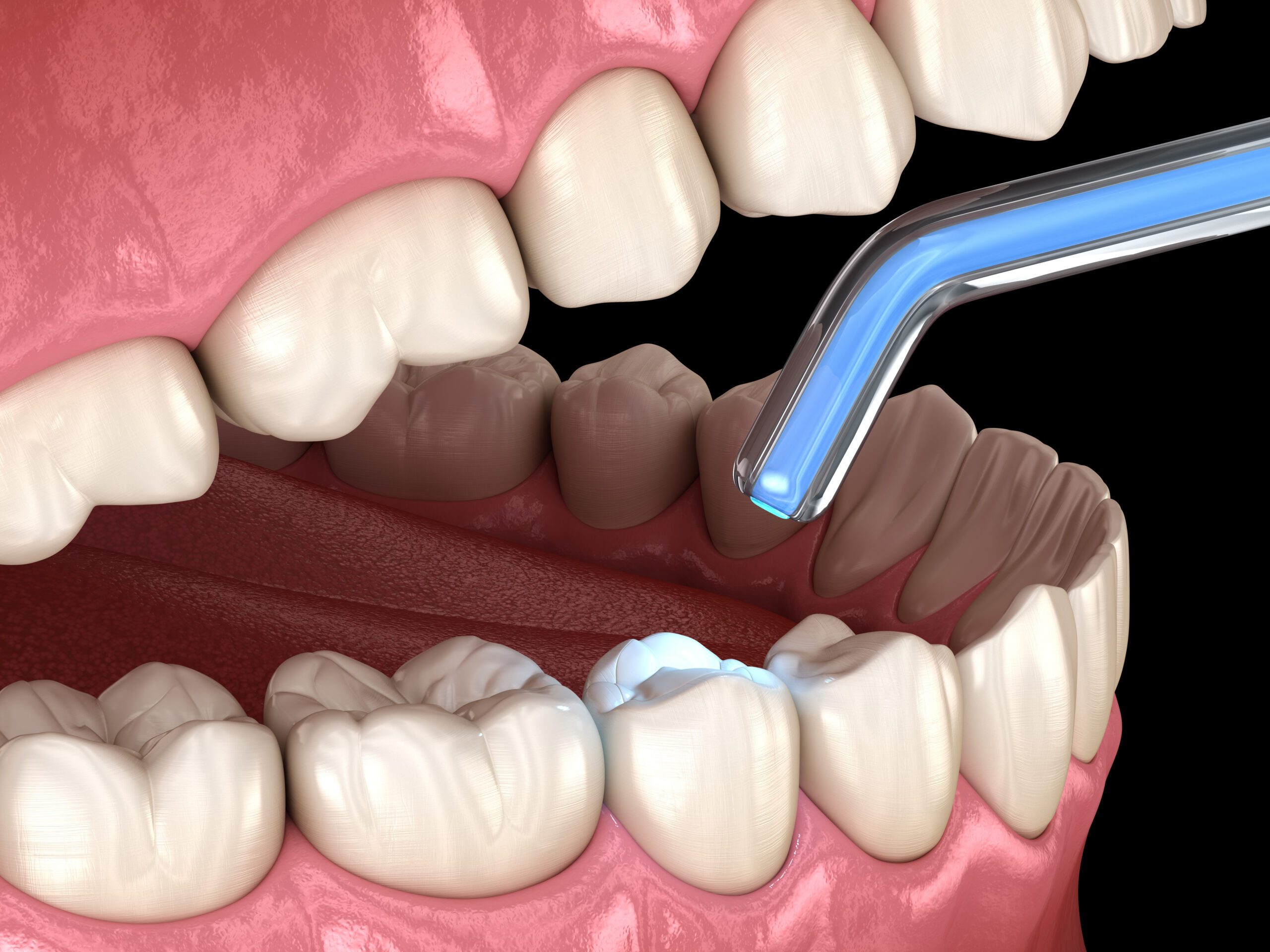 Placing Holistic Dental Fillings Lake Orion, MI