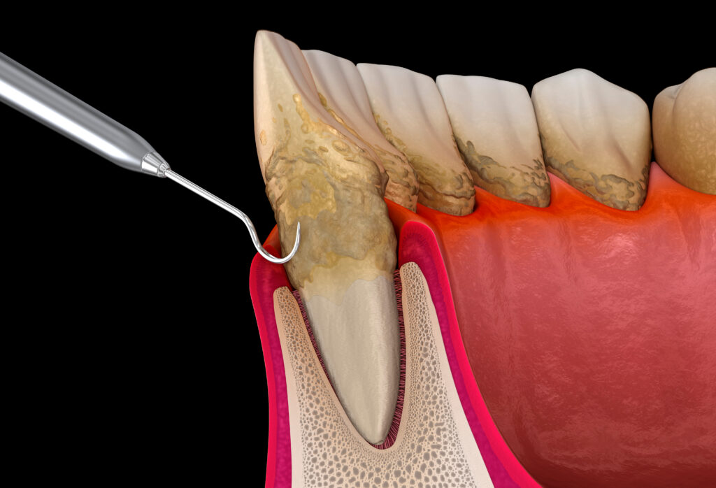 lake orion periodontal disease