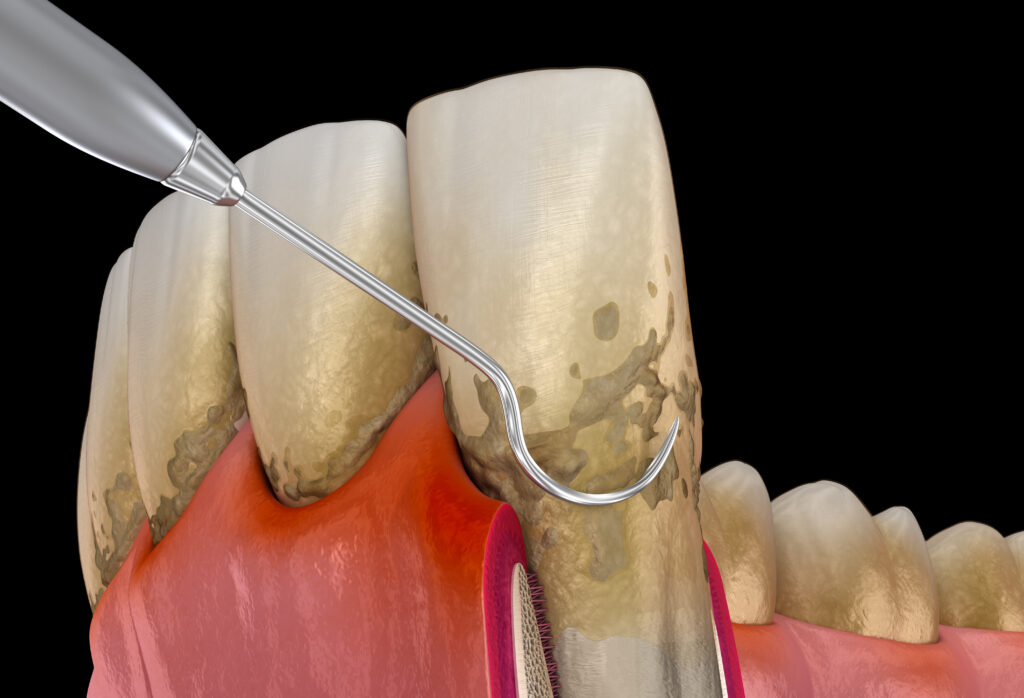 lake orion periodontal cleaning