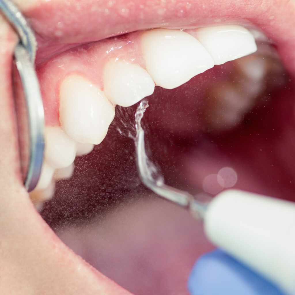 lake orion periodontal cleaning