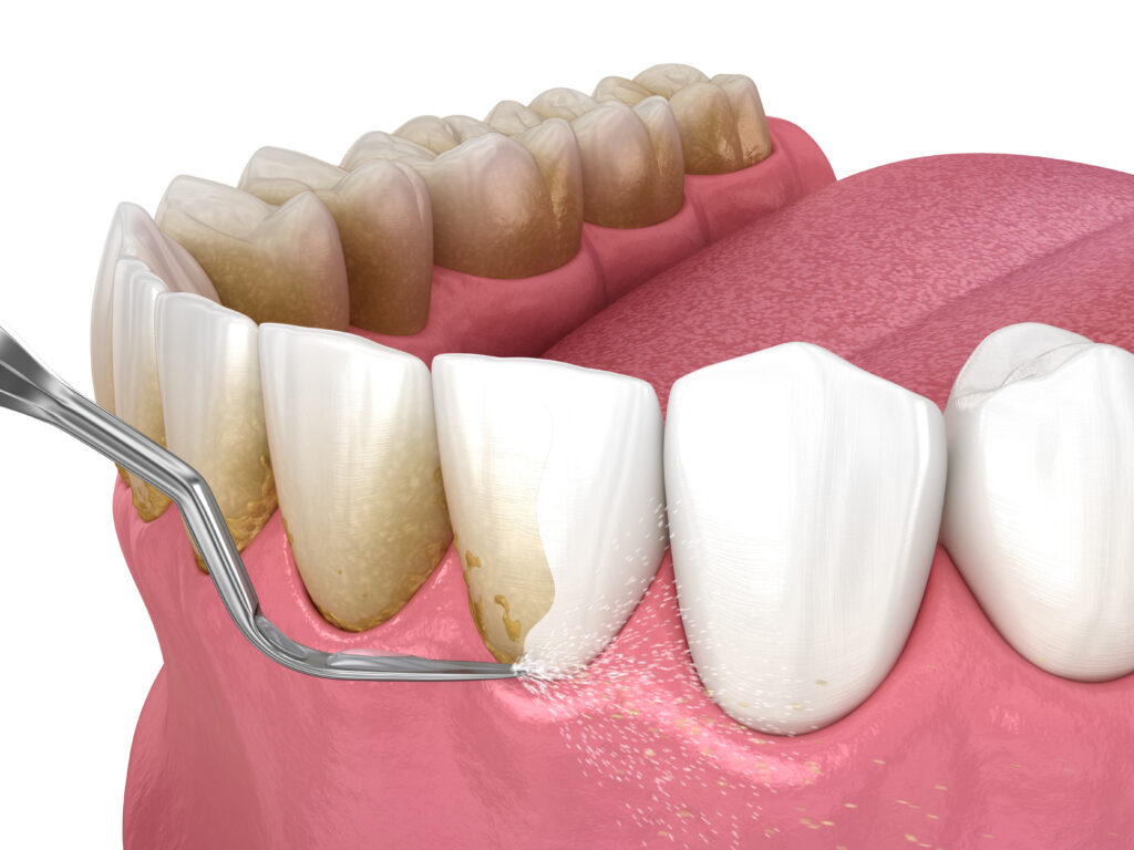 lake orion periodontal cleaning
