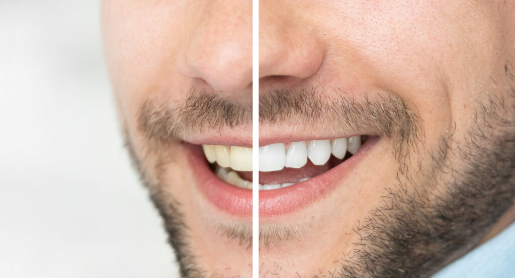 lake orion teeth whitening