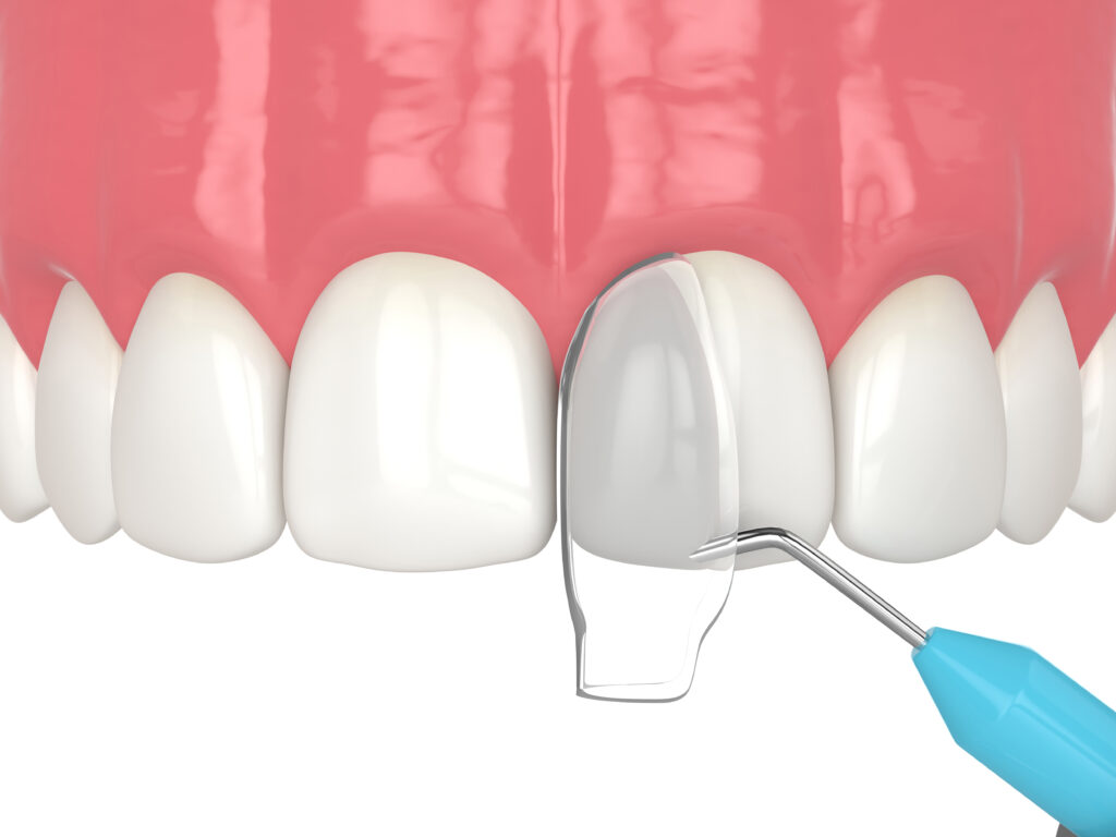 lake orion dental bonding