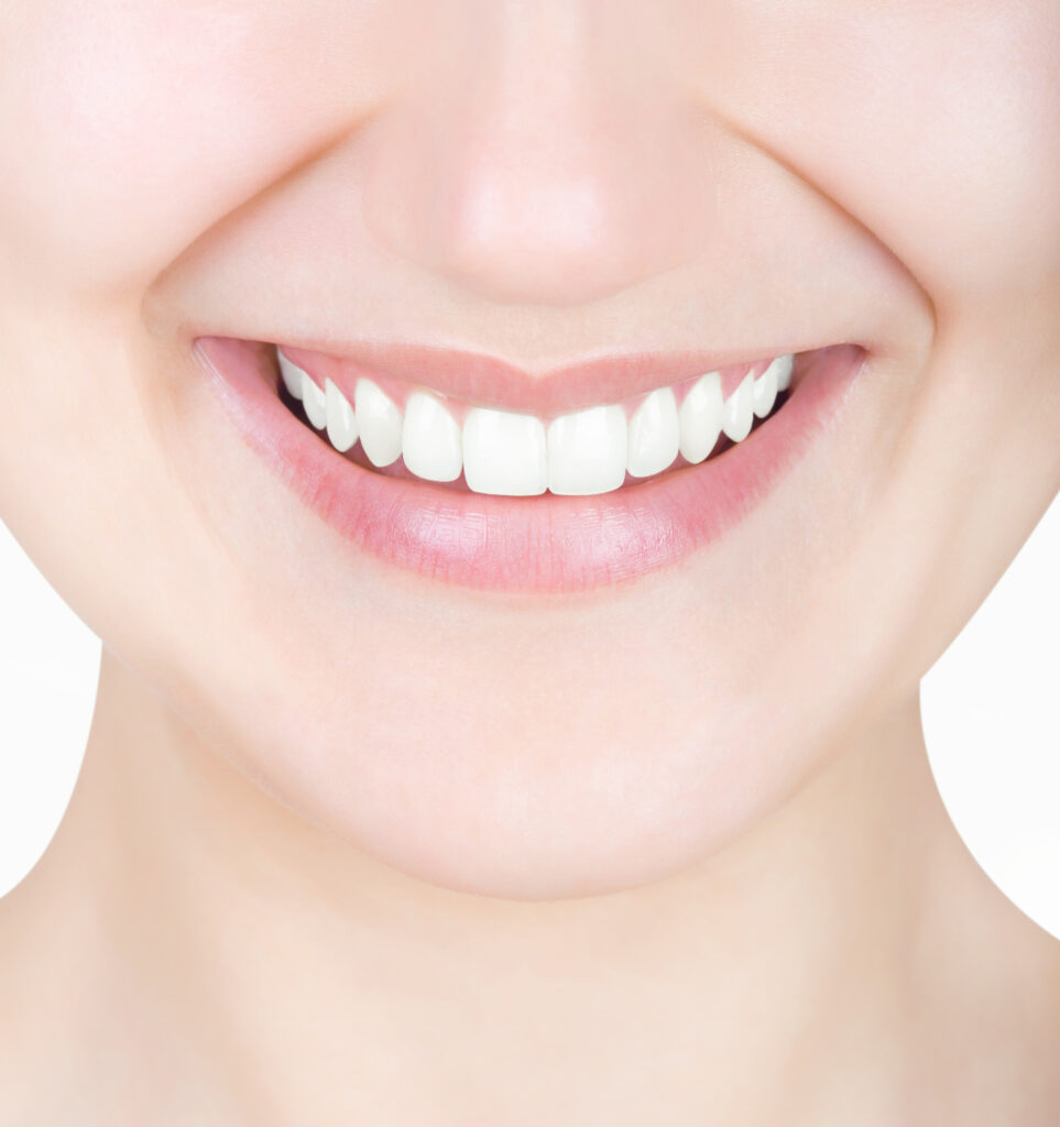 lake orion veneers