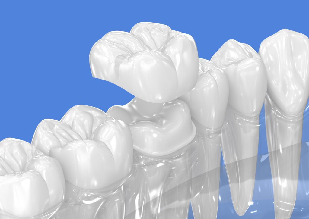 lake orion metal-free dental work