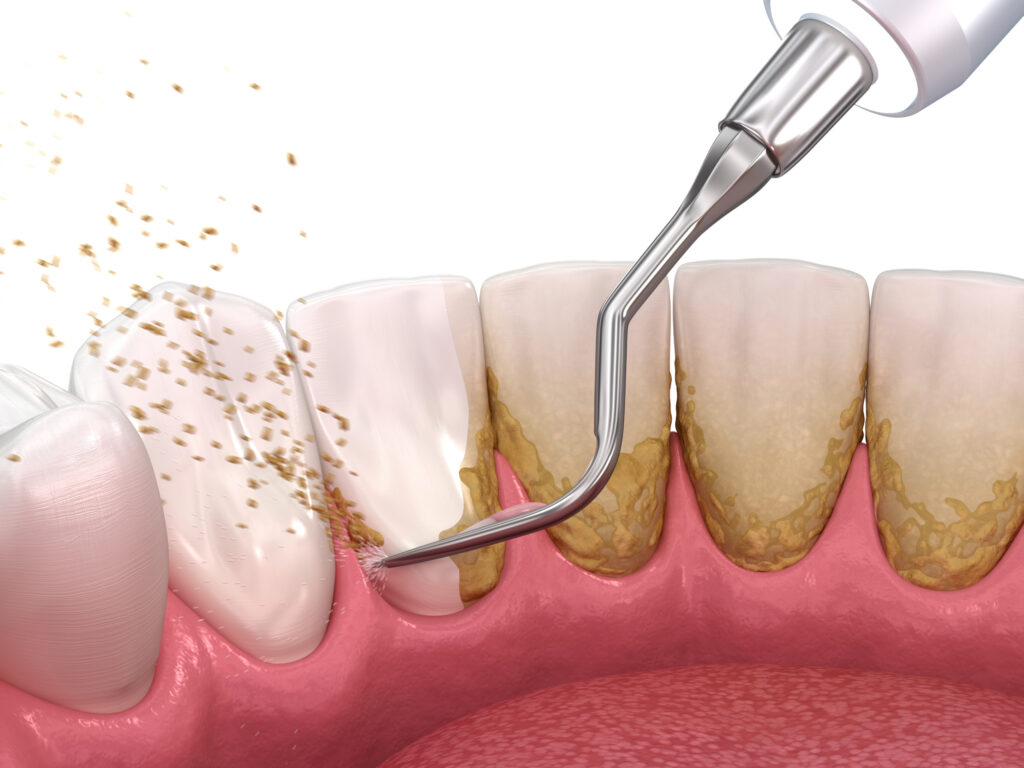 lake orion periodontal cleaning
