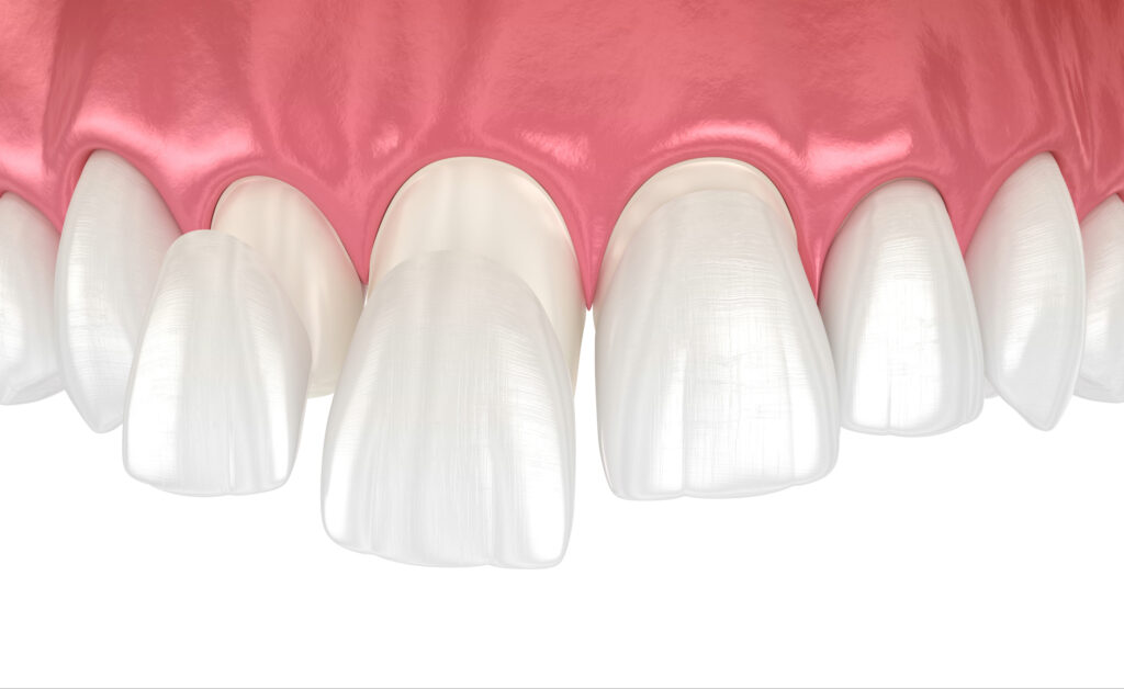 lake orion crowns